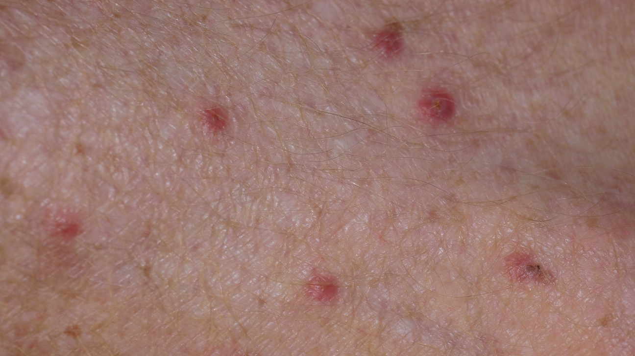 7-photos-carpet-mite-bites-pictures-and-description-alqu-blog