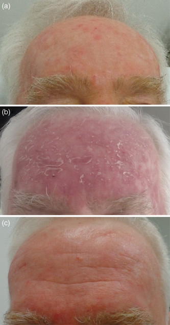 8 Pics Blue Light Photodynamic Therapy For Actinic Keratosis And Review