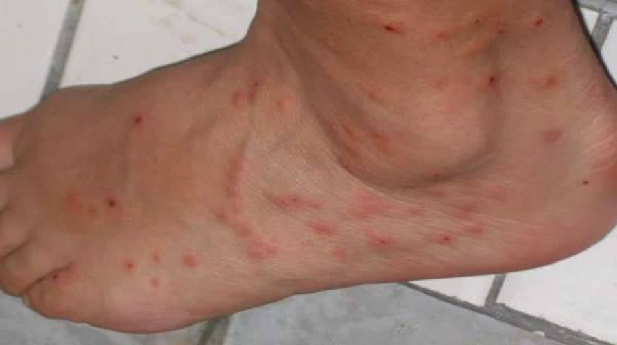 8 Images Carpet Fleas Bites And Review Alqu Blog
